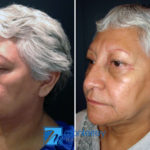 Eyelid Lift photo gallery by Dr. Josue Lara Ontiveros from Monterrey Plastic Surgery.