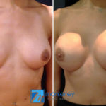 Breast Augmentation photo gallery by Dr. Josue Lara Ontiveros from Monterrey Plastic Surgery.