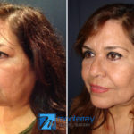 Facelift photo gallery by Dr. Josue Lara Ontiveros from Monterrey Plastic Surgery.