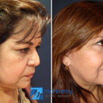 Facelift photo gallery by Dr. Josue Lara Ontiveros from Monterrey Plastic Surgery.