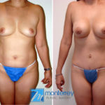 Mommy Makeover photo gallery by Dr. Josue Lara Ontiveros from Monterrey Plastic Surgery.