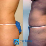 Mommy Makeover photo gallery by Dr. Josue Lara Ontiveros from Monterrey Plastic Surgery.